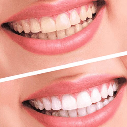 Clareamento-Dental (1)