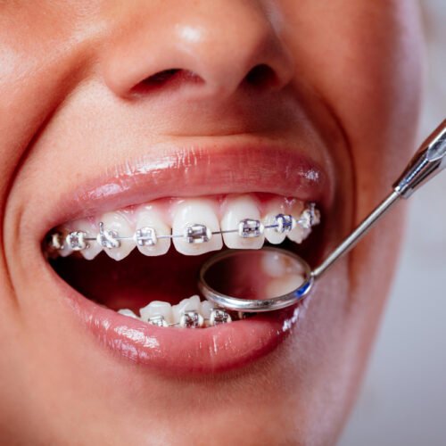 close-up-de-um-dentista-verificando-o-aparelho-com-um-espelho-dental-na-paciente-do-sexo-feminino