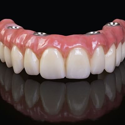 implante-protocolo-superior-all-on-four_dentelli_600x400